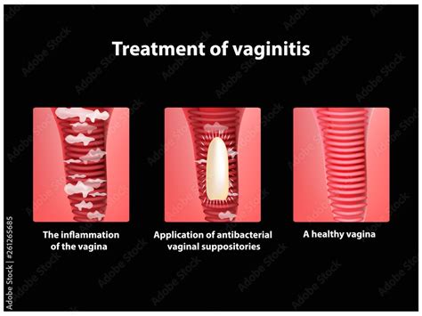 Sexe vaginal classique Putain Massif